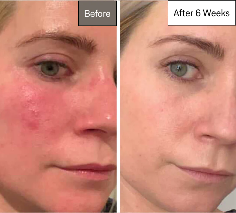 Omnilux Contour Before and After Treatment Results